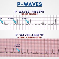 Uniform small spikes on ecg