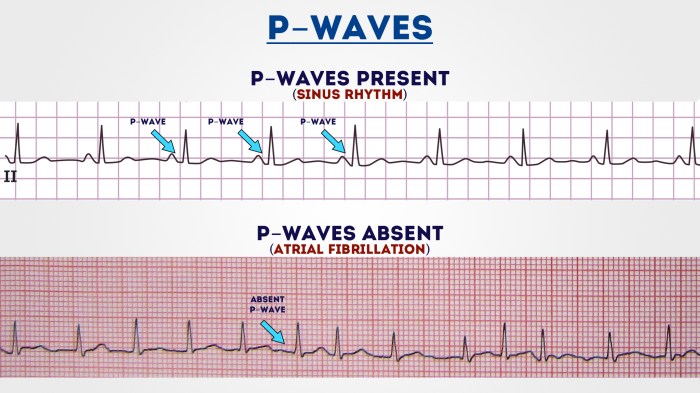 Uniform small spikes on ecg